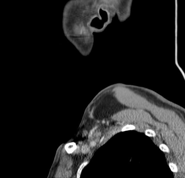 File:Colloid cyst of thyroid (Radiopaedia 22897-22923 Sagittal C+ delayed 6).jpg