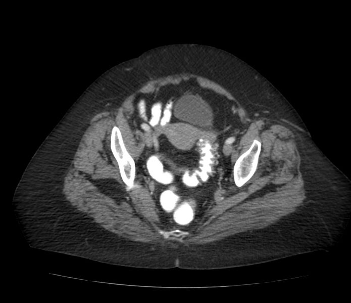 File:Colonic diverticulosis (Radiopaedia 22934-22957 A 63).jpg