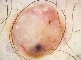 Amelanotic melanoma (Dermoscopic image)