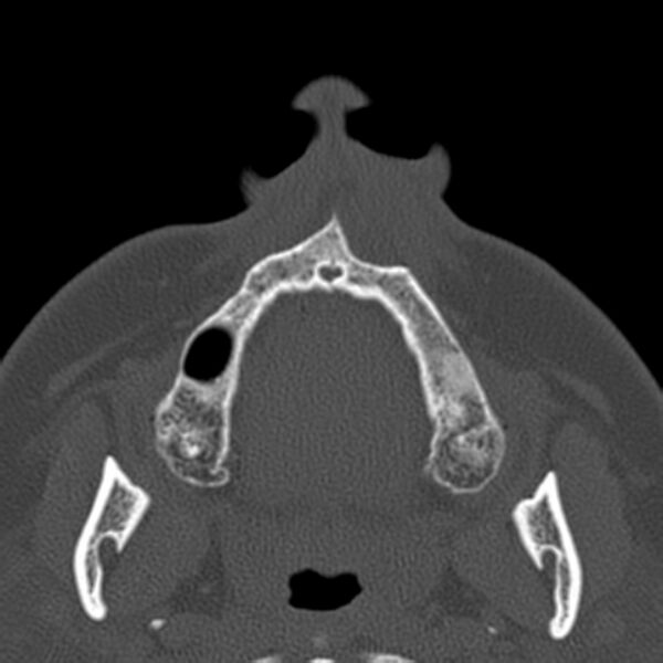File:Nasolabial cyst (Radiopaedia 33987-35205 Axial bone window 4).jpg