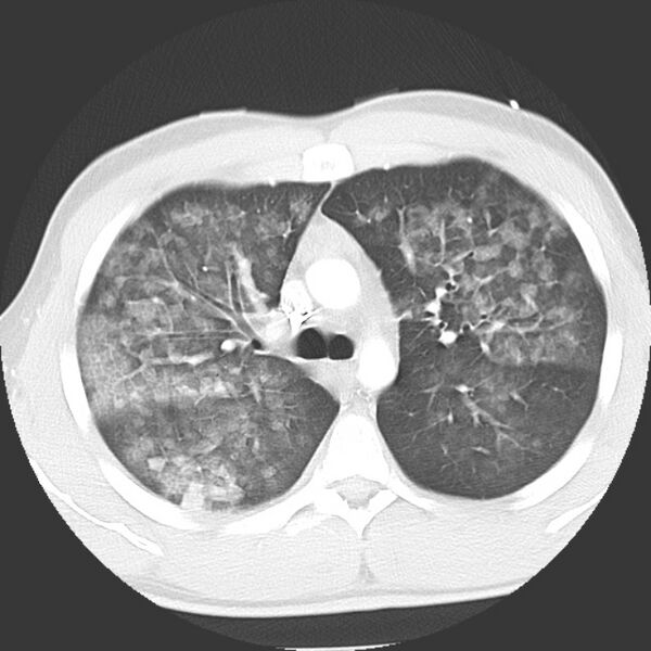 File:Near drowning pulmonary edema (Radiopaedia 16868-16591 Axial lung window 15).jpg