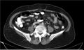 Necrotizing pancreatitis (Radiopaedia 20595-20495 A 29).jpg