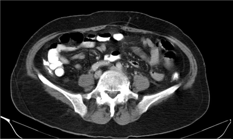 File:Necrotizing pancreatitis (Radiopaedia 20595-20495 A 29).jpg