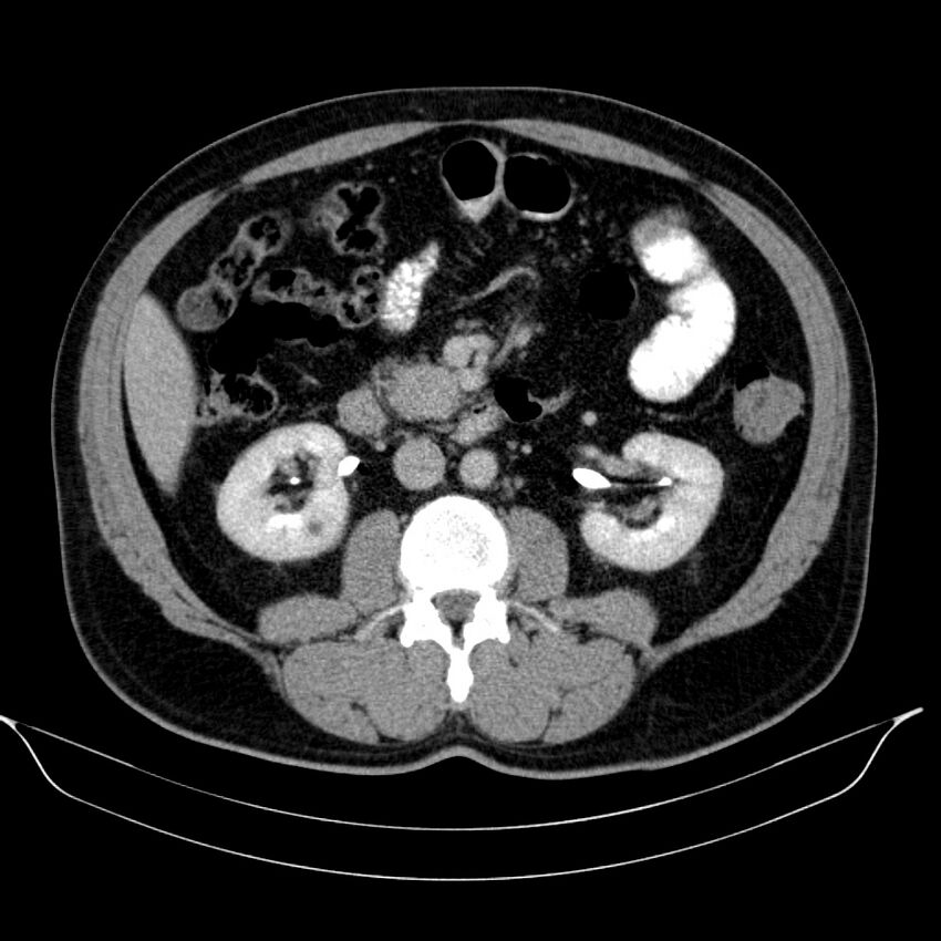 Neuroendocrine tumor of head of pancreas (Radiopaedia 57538-64502 D 40).jpg