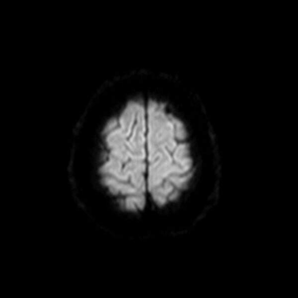 File:Neurofibromatosis type 2 (Radiopaedia 67470-76871 Axial DWI 19).jpg