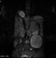 Neurofibromatosis type 2 - cranial and spinal involvement (Radiopaedia 5351-7112 D 1).jpg