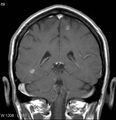 Neurosarcoidosis (Radiopaedia 10930-17204 Coronal T1 C+ 13).jpg