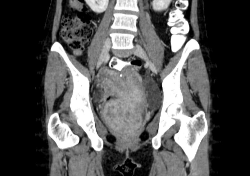 File:Non-puerperal uterine inversion (Radiopaedia 78343-91094 B 12).jpg