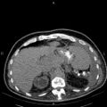 Non Hodgkin lymphoma in a patient with ankylosing spondylitis (Radiopaedia 84323-99621 Axial non-contrast 28).jpg