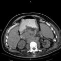 Non Hodgkin lymphoma in a patient with ankylosing spondylitis (Radiopaedia 84323-99621 Axial non-contrast 35).jpg