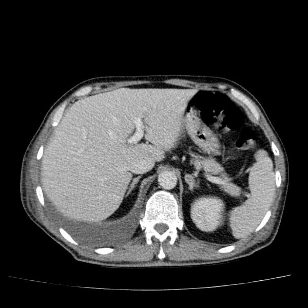 File:Non small-cell lung cancer (Radiopaedia 24467-24769 C+ delayed 59).jpg