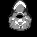Normal CT of the neck (Radiopaedia 14575-14500 Axial C+ 39).jpg