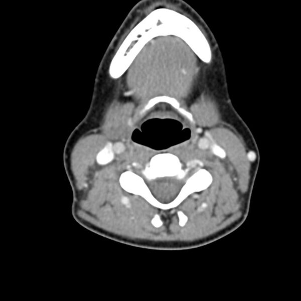 File:Normal CT of the neck (Radiopaedia 14575-14500 Axial C+ 39).jpg