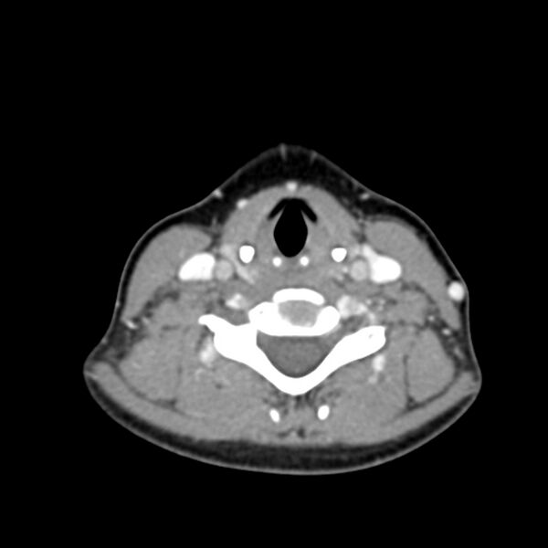 File:Normal CT of the neck (Radiopaedia 14575-14500 Axial C+ 45).jpg