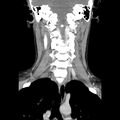 Normal CT of the neck (Radiopaedia 14575-14500 Coronal C+ 33).jpg