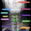 Normal cervical spine radiographs (Radiopaedia 32505-96697 B 2).jpeg