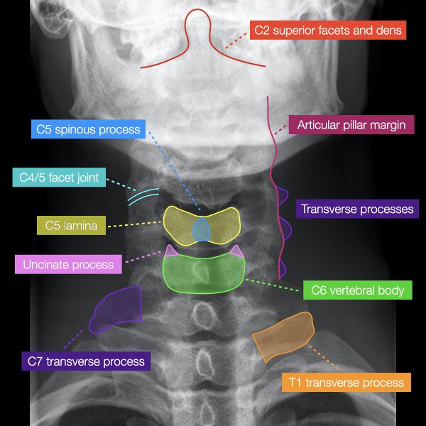File:Normal cervical spine radiographs (Radiopaedia 32505-96697 B 2).jpeg