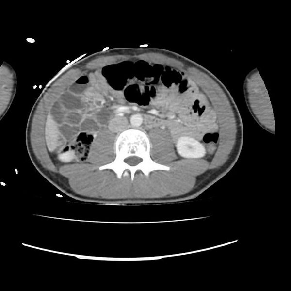 File:Normal dual-phase trauma CT chest,abdomen and pelvis (Radiopaedia 48092-52899 A 73).jpg