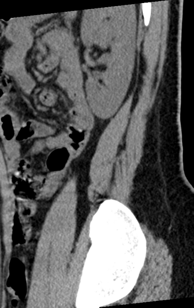 File:Normal lumbar spine CT (Radiopaedia 46533-50986 C 8).png