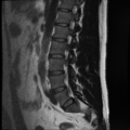 Normal lumbar spine MRI (Radiopaedia 35543-37039 Sagittal T2 4).png
