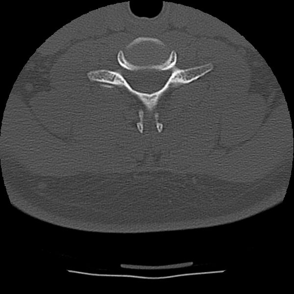 File:Normal trauma spine imaging (Radiopaedia 31753-32686 Axial bone window 62).jpg