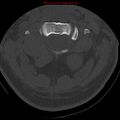 Occipital condyle fracture (Radiopaedia 18366-18208 Axial bone window 22).jpg