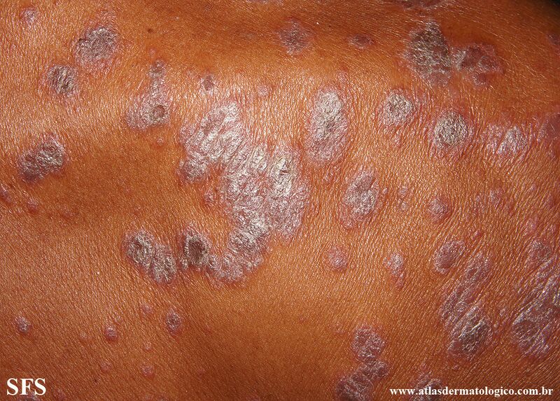 File:Psoriasis (Dermatology Atlas 144).jpg