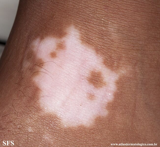 File:Vitiligo (Dermatology Atlas 51).jpg