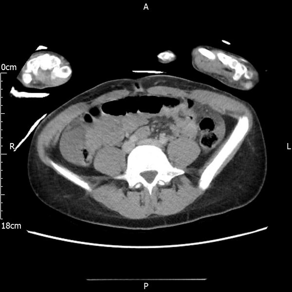File:AAST grade IV kidney injury with CEUS follow-up (Radiopaedia 72353-82877 Axial C+ portal venous phase 47).jpg