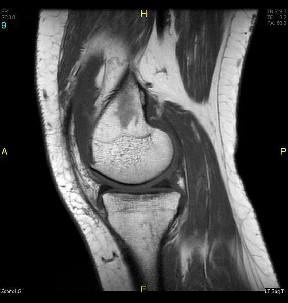 File:ACL mucoid degeration with cystic changes (Radiopaedia 48428-53341 Sagittal T1 7).jpg