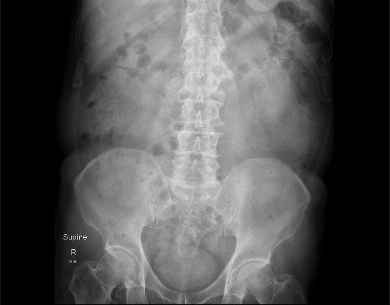 File:Abdomen x-ray (annotated) (Radiopaedia 56646-63430 B 1).jpg