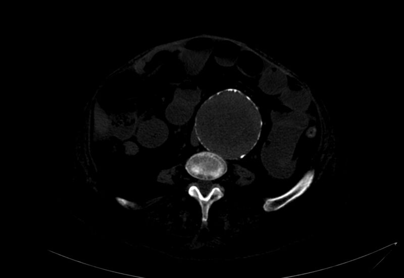 File:Abdominal aortic aneurysm - impending rupture (Radiopaedia 19233-19246 B 26).jpg