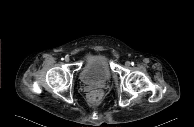 File:Abdominal aortic interposition tube graft and aneurysm thrombosis (Radiopaedia 71438-81857 Axial C+ arterial phase 235).jpg
