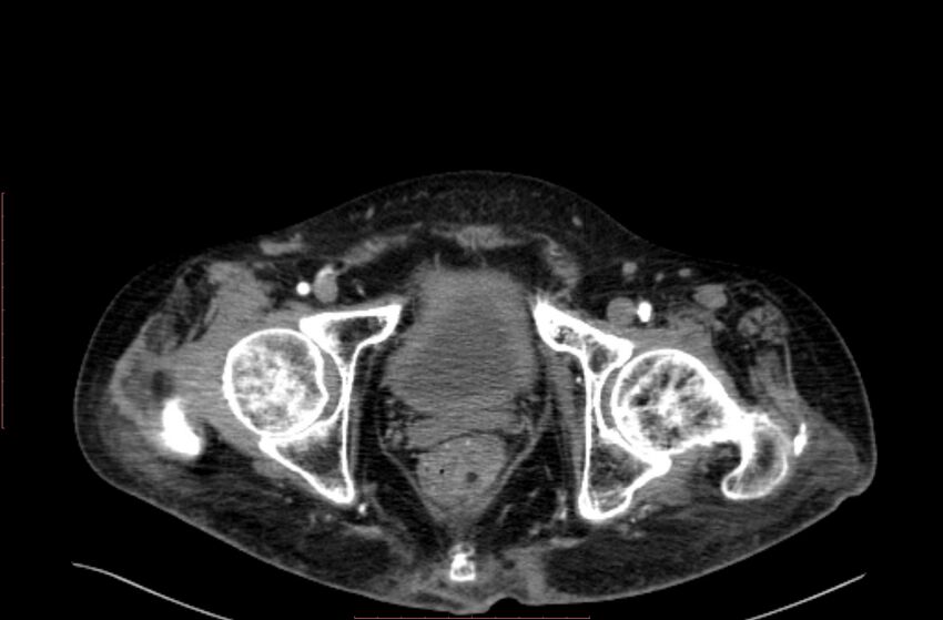 Abdominal aortic interposition tube graft and aneurysm thrombosis (Radiopaedia 71438-81857 Axial C+ arterial phase 235).jpg