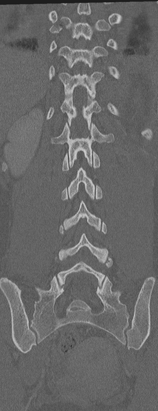 File:Abdominal multi-trauma - devascularised kidney and liver, spleen and pancreatic lacerations (Radiopaedia 34984-36486 Coronal bone window 49).png