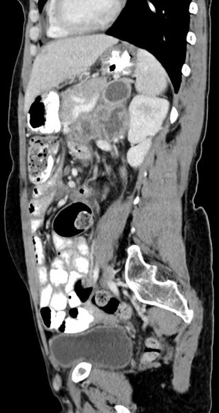 File:Abdominal wall and retroperitoneal tuberculosis (Radiopaedia 88137-104729 Sagittal C+ portal venous phase 58).jpg