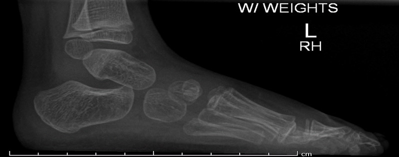 File:Absent navicular with background Kabuki syndrome (Radiopaedia 56133-62785 Lateral 1).png