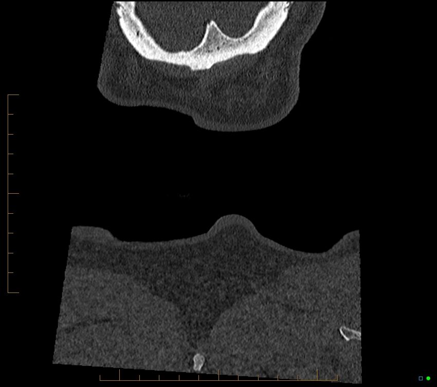 Accessory articulation of cervical transverse processes (Radiopaedia 82715-96933 Coronal non-contrast 134).jpg