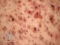 Acne affecting the back images (DermNet NZ acne-acne-back-193).jpg