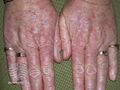 Actinic Keratoses treated with imiquimod (DermNet NZ lesions-ak-imiquimod-3752).jpg