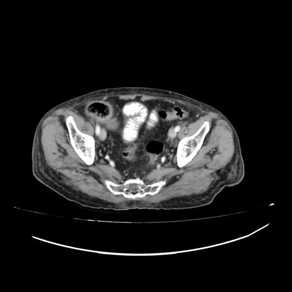 File:Acute-on-chronic Crohn disease with enteroenteric fistula (Radiopaedia 66686-75987 B 65).jpg