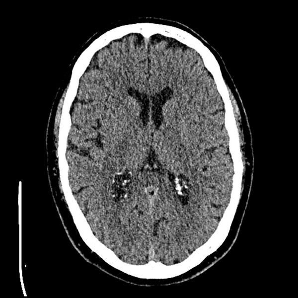 File:Acute A3 occlusion with ACA ischemic penumbra (CT perfusion) (Radiopaedia 72036-82525 Axial non-contrast thins 40).jpg