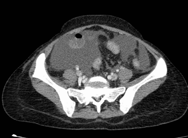 File:Acute Budd-Chiari syndrome (Radiopaedia 60858-68638 Axial C+ portal venous phase 221).jpg