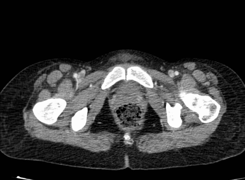 File:Acute Budd-Chiari syndrome (Radiopaedia 60858-68638 Axial C+ portal venous phase 300).jpg