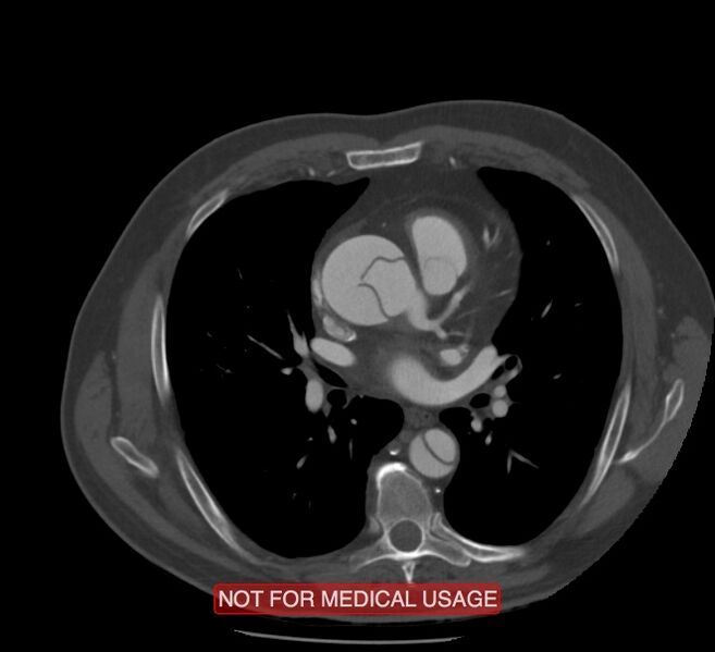 File:Acute aortic dissection - Stanford type A (Radiopaedia 40661-43285 Axial C+ arterial phase 32).jpg