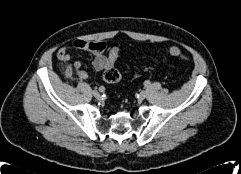 File:Acute appendicitis (Radiopaedia 13030-13091 Axial non-contrast 50).jpg