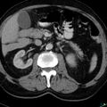 Acute appendicitis arising from a malrotated cecum (Radiopaedia 19970-19997 Axial C+ portal venous phase 8).jpg