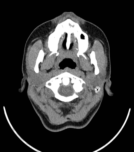 File:Acute bacterial tonsillitis (Radiopaedia 22882-22908 Axial non-contrast 10).png