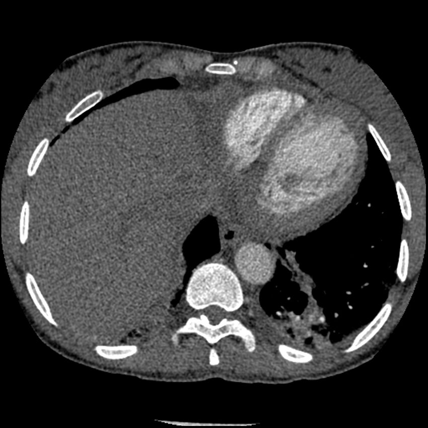 Acute chest syndrome - sickle cell disease (Radiopaedia 42375-45499 Axial C+ CTPA 152).jpg