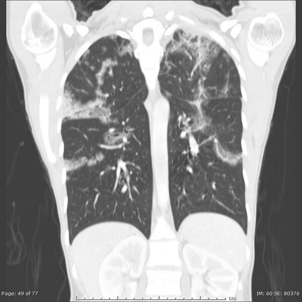 File:Acute eosinophilic pneumonia (Radiopaedia 48211-53073 Coronal 14).jpg